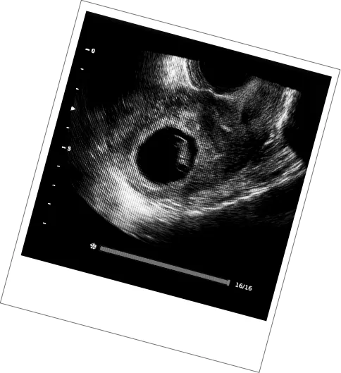 Early Reassurance Scan