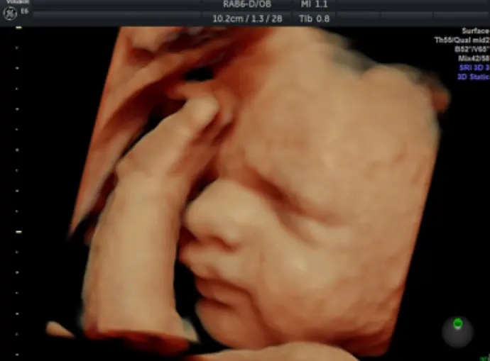 32 week ultrasound scan