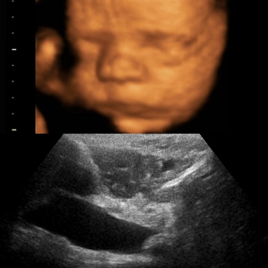 2D vs 4D ultrasound scan