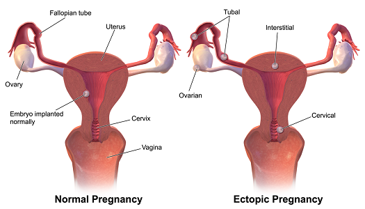 Ectopic pregnancy diagrams