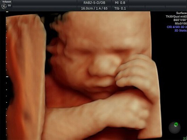 High-Quality 3D/4D Baby Scan